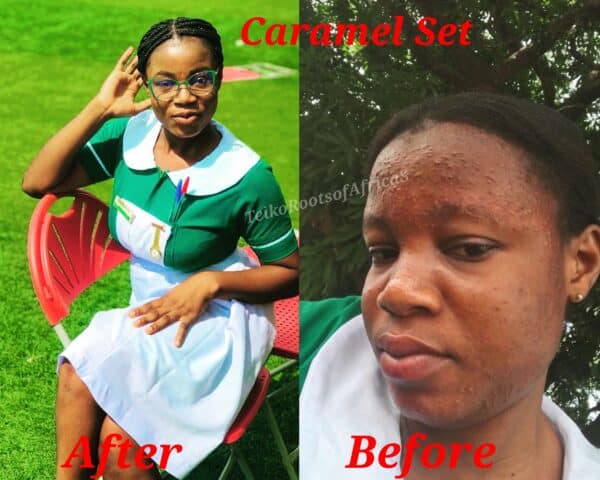 Before and After Review on Caramel Skin Set